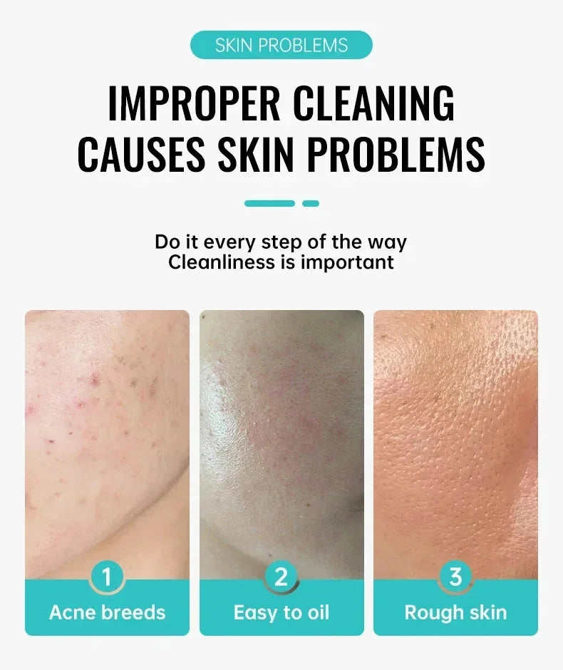 PWYUMAN Salicylic Acid Anti-Acne Cream – Oil Control, Scar Repair & Moisturizer (30ml)