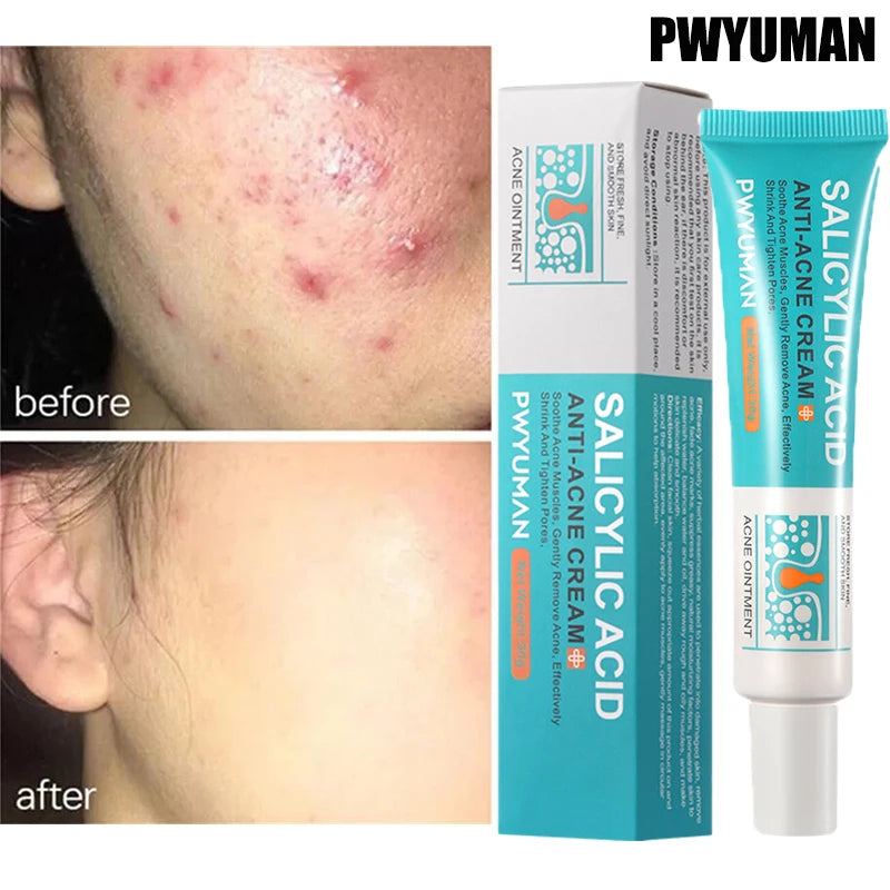 PWYUMAN Salicylic Acid Anti-Acne Cream – Oil Control, Scar Repair & Moisturizer (30ml)